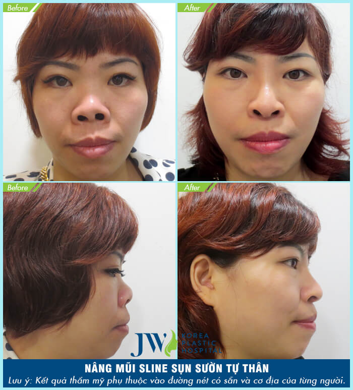 Nâng mũi bằng sụn sườn-hình 7