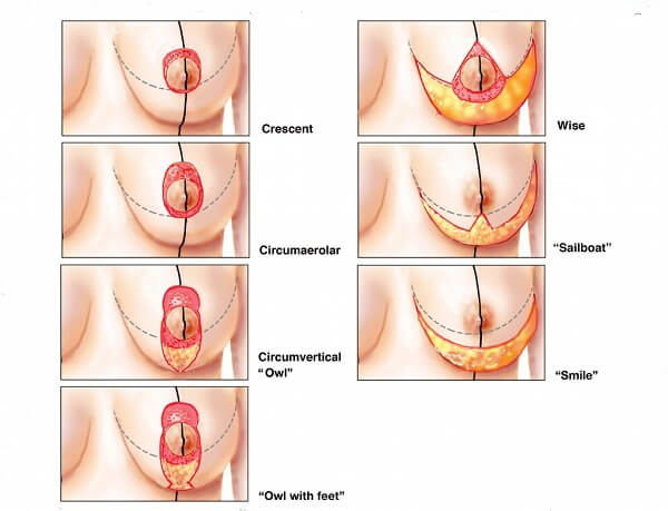 Treo tuyến ngực cải thiện vòng một chảy xệ sau sinh - Ảnh 3