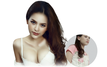 trước và sau phẫu thuật thẩm mỹ