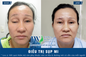Giải cứu đôi mắt sụp mi suốt 48 năm cho người phụ nữ Củ Chi
