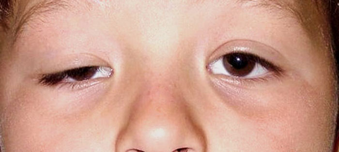 5 nguyên nhân gây sụp mí mắt và cách điều trị hiệu quả - Ảnh 2