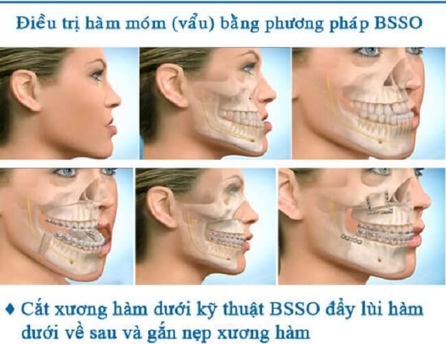 Phẫu thuật khuôn mặt bất cân xứng_4