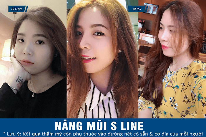 Nâng mũi S line hết bao nhiêu tiền_4