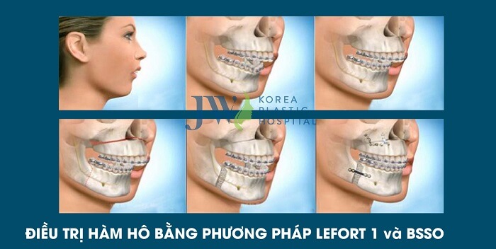 Phẫu thuật khuôn mặt bất cân xứng_3