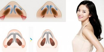 Cắt cánh mũi có hại không – Giải đáp từ A đến Z về thẩm mỹ mũi