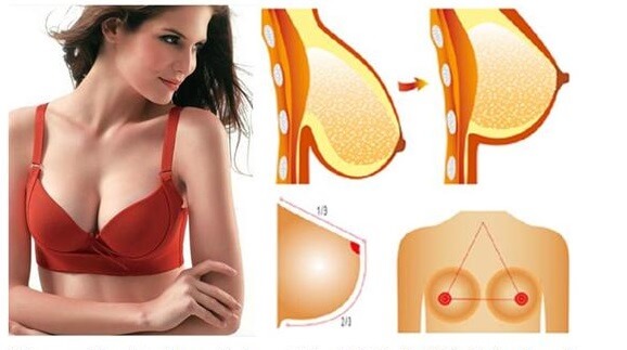 Các cách phẫu thuật nâng ngực - 3 biện pháp nâng ngực an toàn - Ảnh 5