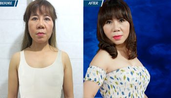 Nỗi ám ảnh mang tên vòng một sau sinh