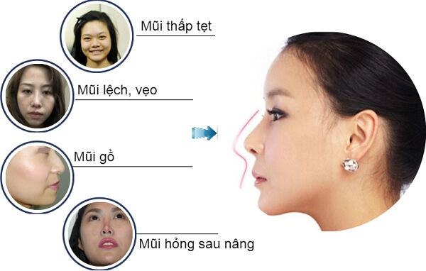 Giải đáp nâng mũi xong có được nằm nghiêng không-hình 2