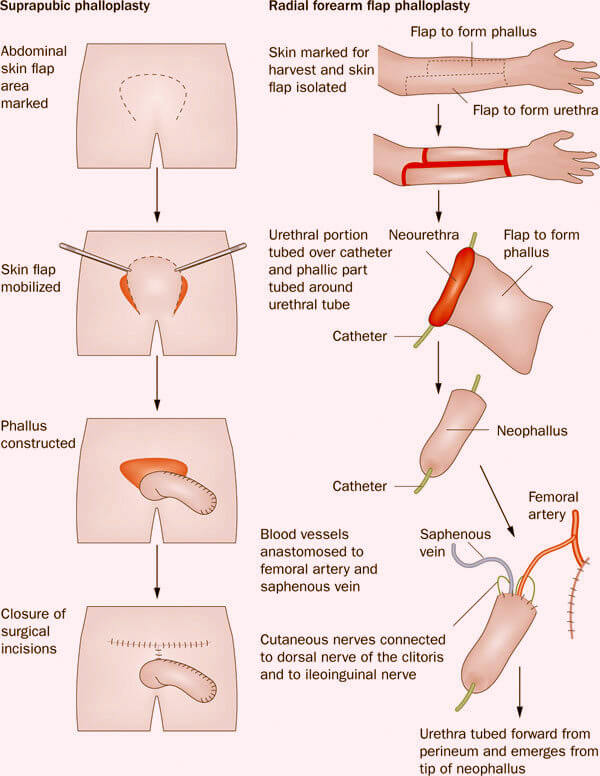 Phẫu thuật chuyển giới bộ phận sinh dục - Tạo dương vật giả - Ảnh 3
