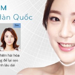 Giá độn cằm V Line – Công nghệ độc quyền Hàn Quốc