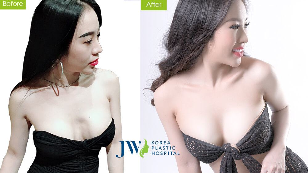 DJ Tuyết Nhung cải thiện dáng ngực để có thân hình quyến rũ