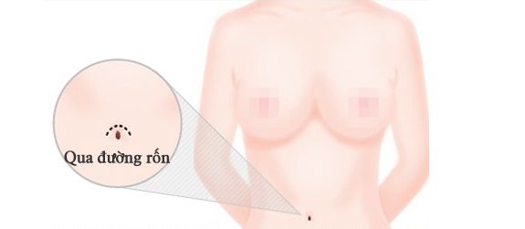 Nâng ngực nội soi qua đường rốn có tốt không - hình 2