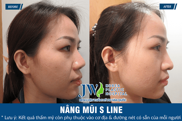 Chi phí nâng mũi cấu trúc là bao nhiêu - hình 7