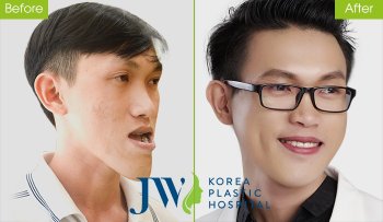 Phẫu thuật cắt xương hàm giá bao nhiêu tiền? Bảng giá phẫu thuật hàm mặt mới nhất 2024