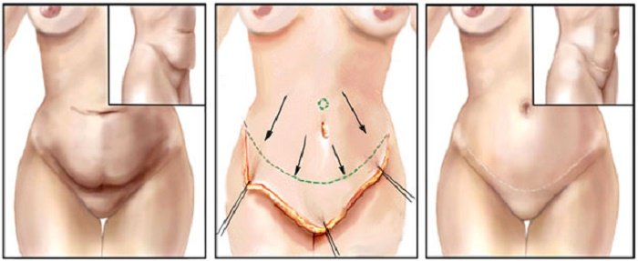 Căng da bụng ở đâu đẹp và an toàn tại TP.HCM- hình 2