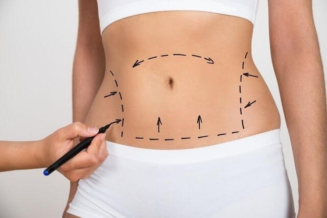Căng da bụng có đau không – Những điều cần biết về phương pháp này - hình 2