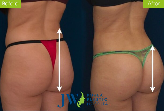 Hình ảnh khác biệt trước và sau khi nâng mông nội soi
