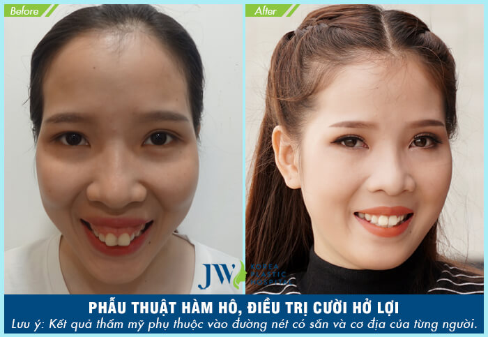 Phẫu thuật cắt xương hàm có nguy hiểm không - hình 6