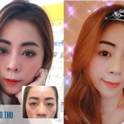 Nhờ cắt mí mắt, nữ DJ cá tính “lột xác” thành quý cô hoàn hảo