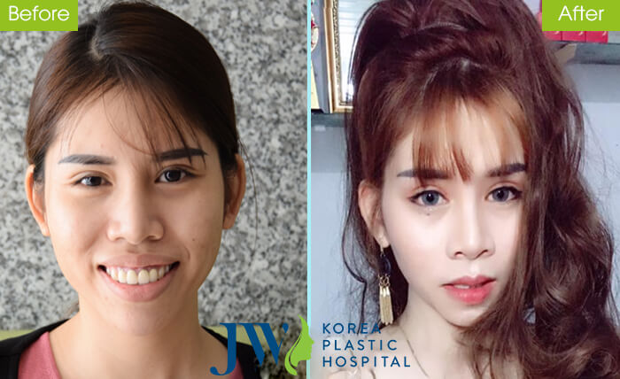 Khách hàng Kim Anh (23 tuổi, Bình Thuận) sở hữu gương mặt "vạn người mê" sau phẫu thuật hàm hô.
