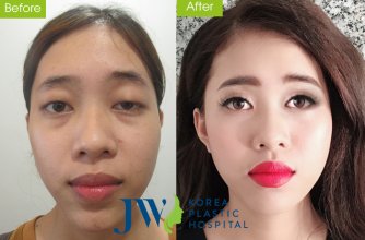 Cuộc đời sang trang của cô gái Bến Tre nhờ phẫu thuật thẩm mỹ