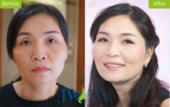 45 Phút giải tỏa nỗi “ám ảnh” cắt mí mắt không thành sau 10 năm