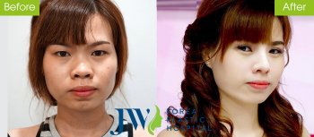 Cô giáo Cần Thơ “đổi đời” nhờ cắt mắt, sửa mũi