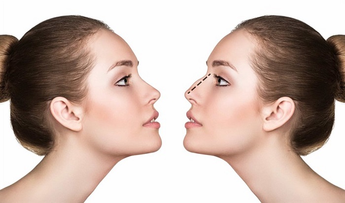 Nguyên nhân nâng mũi bị biến chứng và giải pháp khắc phục an toàn - hình 1
