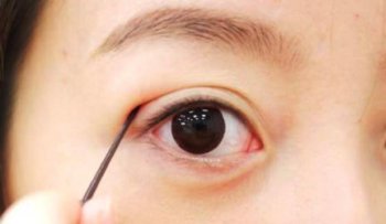 Cắt mí mắt hỏng, “tiền mất tật mang” vì thiếu hiểu biết
