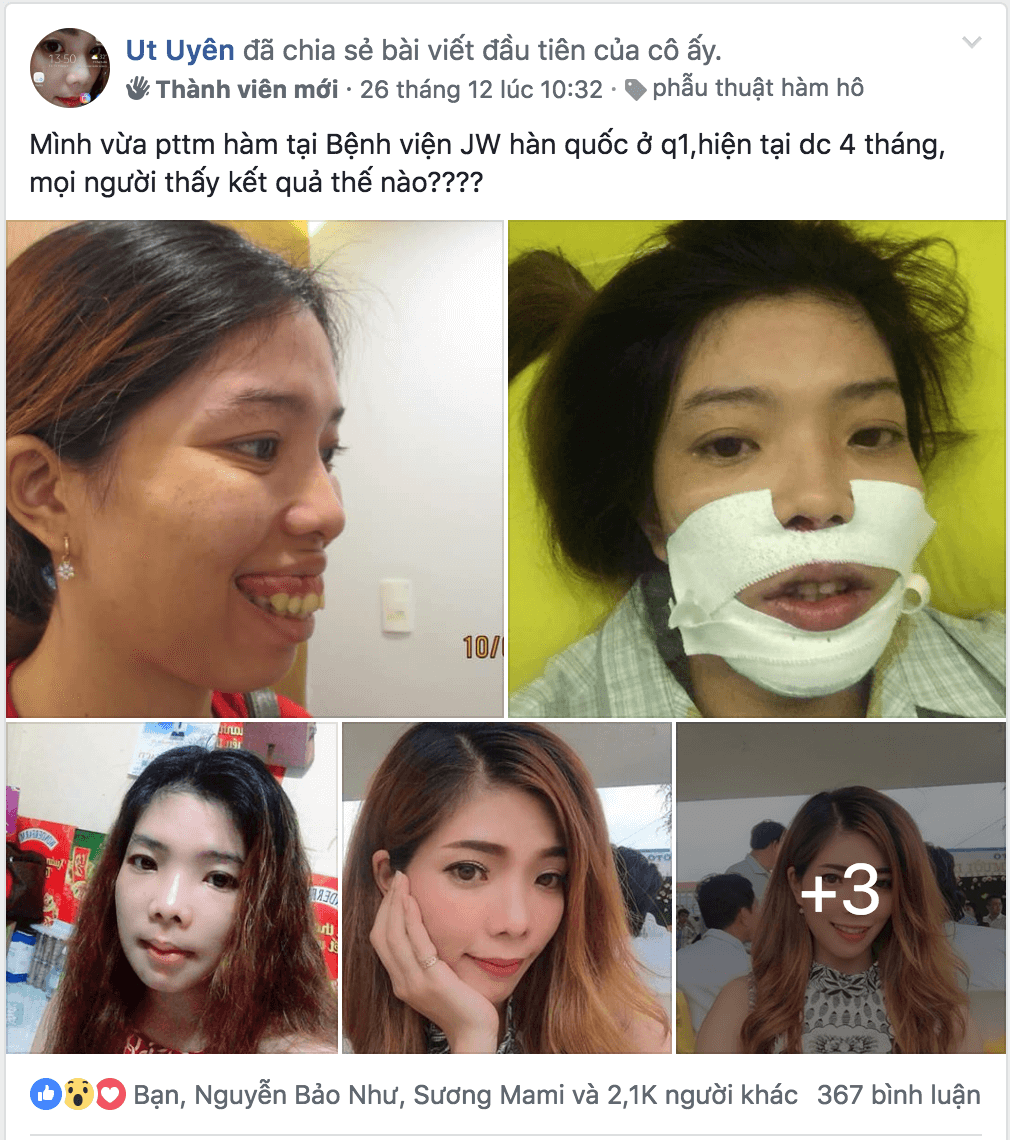 Hình ảnh Ut Uyên chia sẻ thu hút hàng ngàn lượt like, share và comment  - Phẫu thuật hàm móm