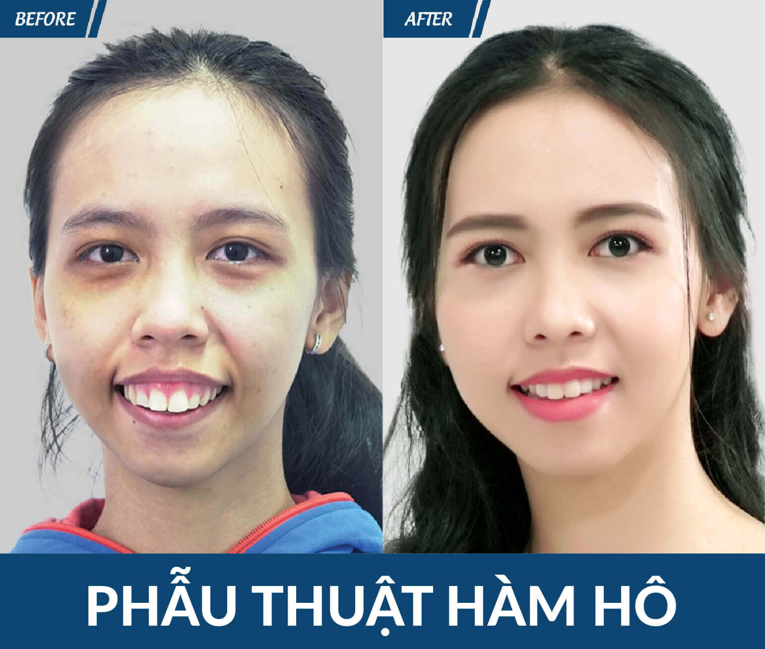 phau thuat ham ho tai jw