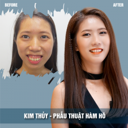 Phẫu thuật hàm hô miễn phí ở đâu?