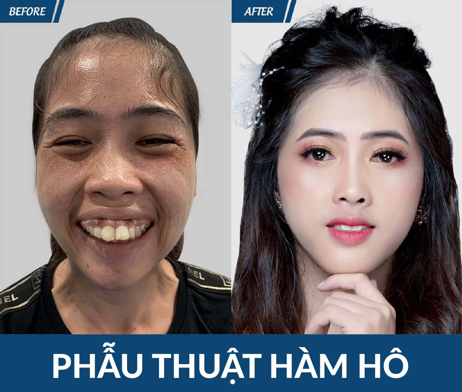 phau thuat ham