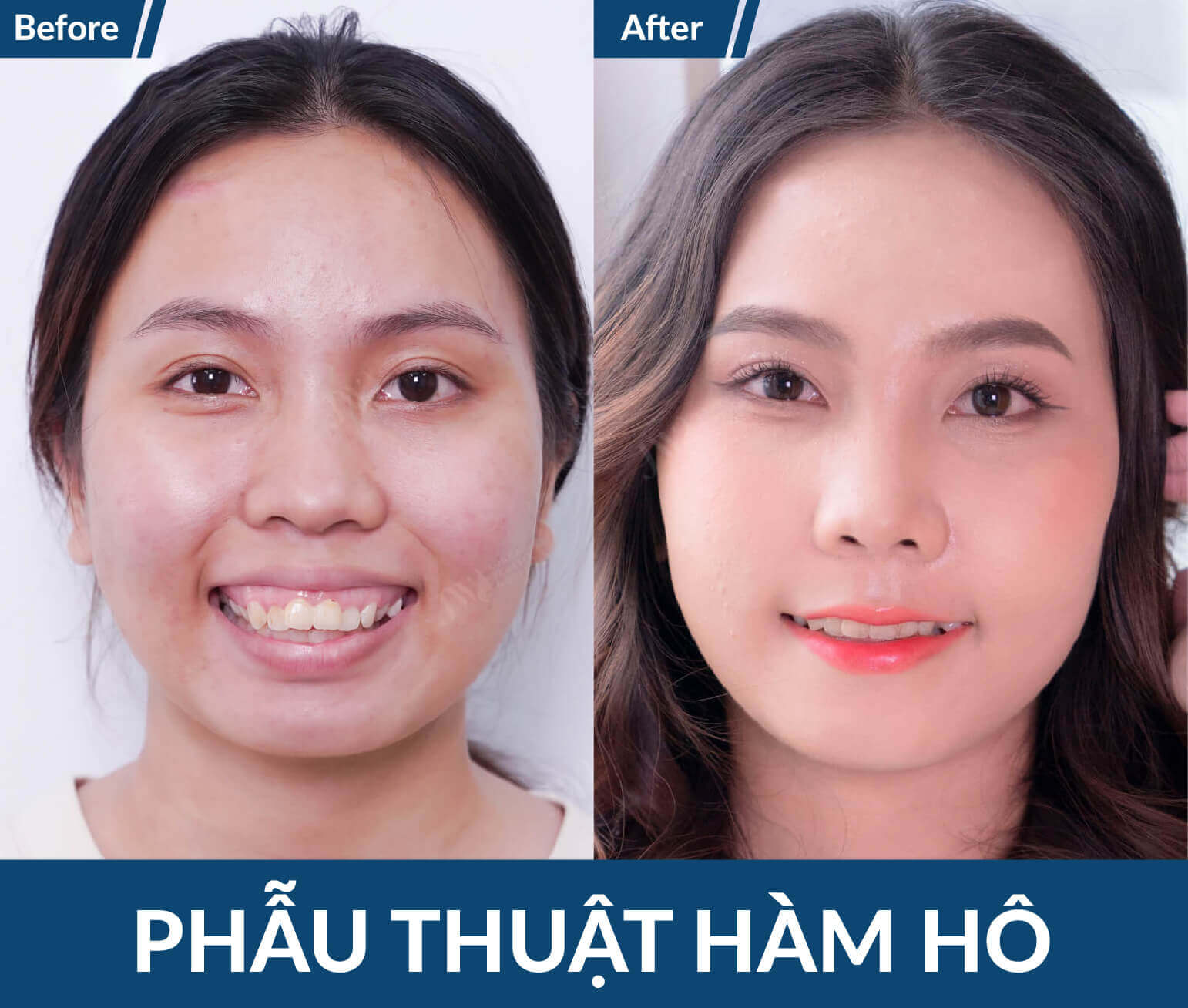 cong nghe phau thuat ham