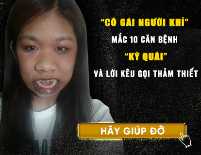 Câu chuyện cô gái 'khỉ đột' 22 năm luôn há miệng