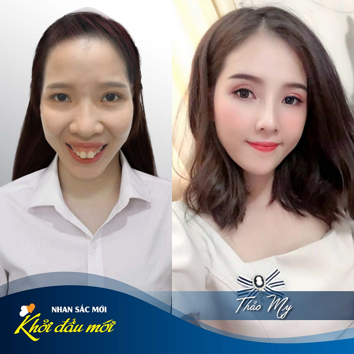 thay đổi sau phẫu thuật hàm hô móm