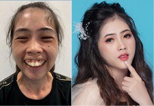 Phẫu thuật hàm hô hoàn thiện chức năng ăn nhai cho 9X Bình Thuận