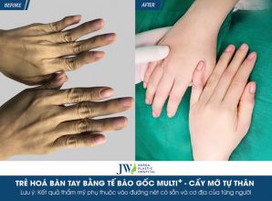 Biến bàn tay bà lão 80 thành “Bàn Tay Baby” nhờ tế bào gốc Multi ᐩ