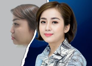 Cô lễ tân nâng mũi “Thay sắc đổi vận”