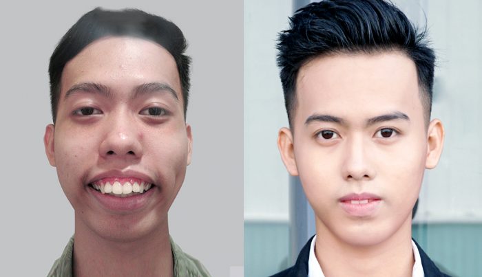 nguyễn văn minh phẫu thuật hàm hô