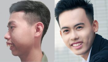 Nam sinh viên “nạo dừa” vỡ òa hạnh phúc sau cắt hàm