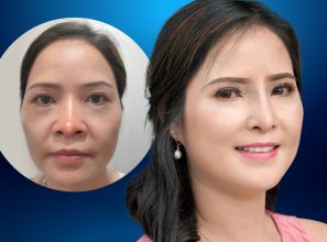 Cô gái Hà Lan vượt vạn dặm đến Việt Nam cứu chữa chiếc mũi 10 năm biến dạng