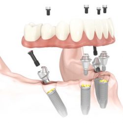 Cấy ghép implant All on 4 – All on 6 bí quyết lấy lại toàn hàm răng đã mất