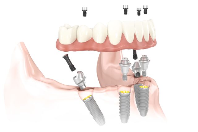 Cấy ghép implant All on 4 – All on 6 bí quyết lấy lại toàn hàm răng đã mất