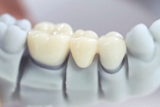 Bọc răng sứ – Giải pháp giản đơn cho nụ cười xinh xắn