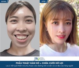 Phân biệt phẫu thuật cười hở lợi với phẫu thuật hàm hô