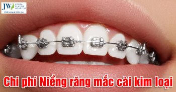 niềng răng mắc cài kim loại
