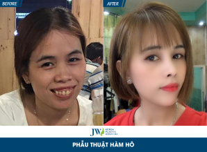 8X Đồng Nai bất ngờ “đổi đời” sau phẫu thuật hàm hô