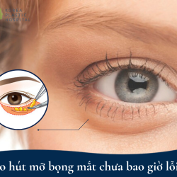 Lý do hút mỡ bọng mắt chưa bao giờ lỗi thời?