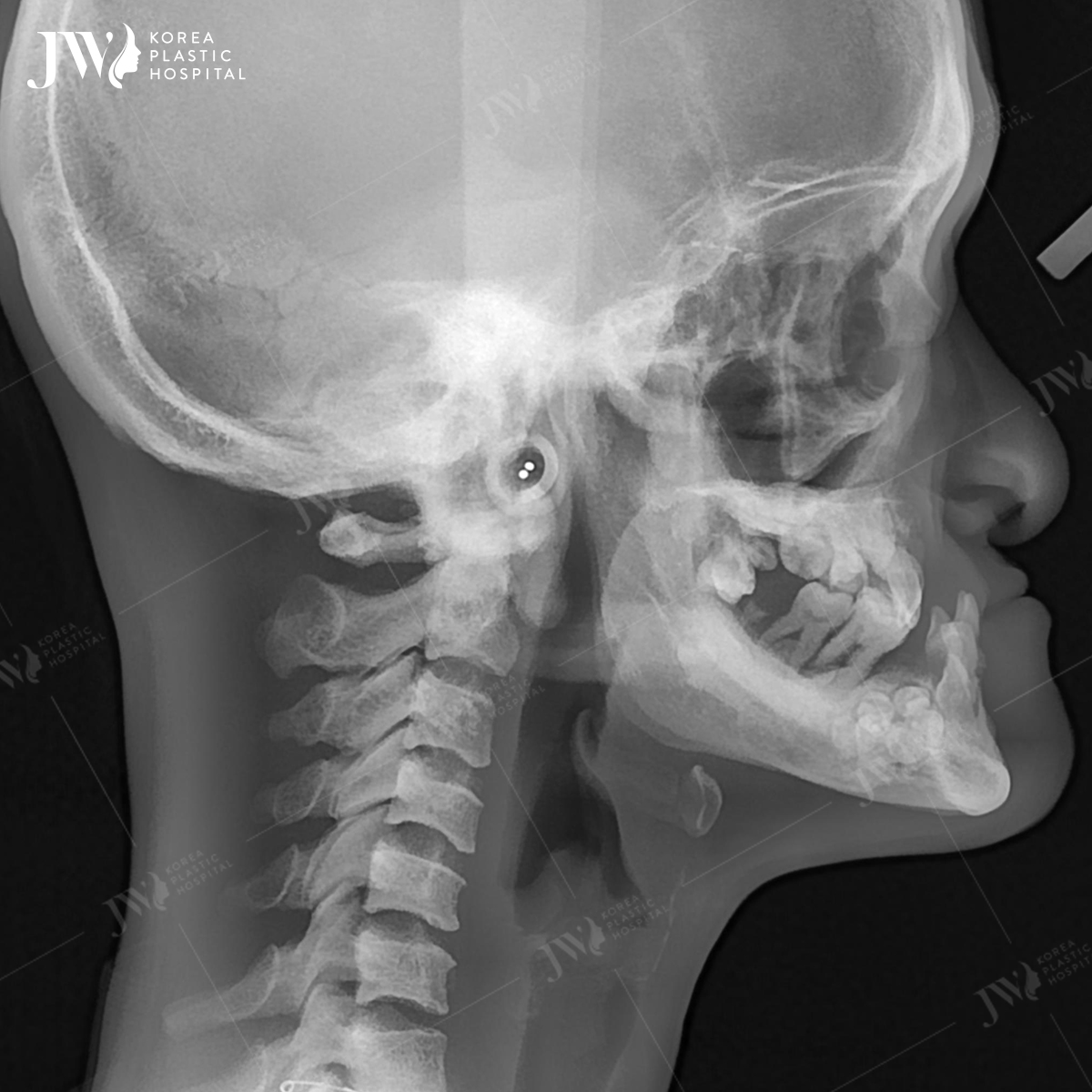 Hình chụp X - quang góc phải của N.H.V